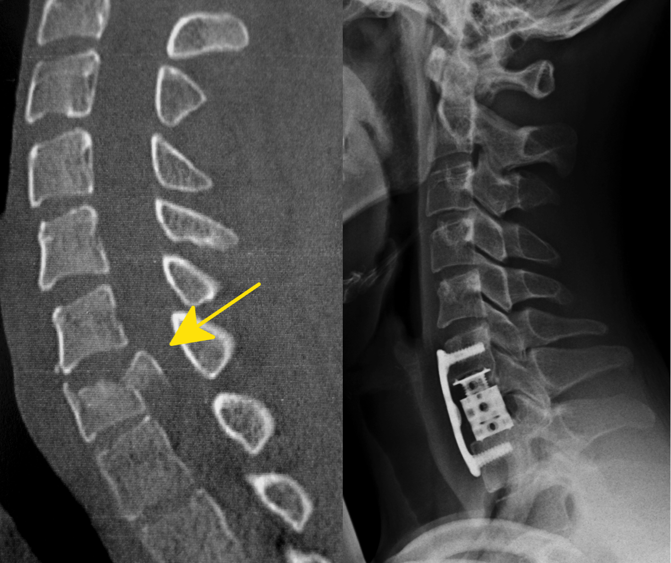Eine Fraktur der Halswirbelsäule vor und nach der Operation. Hier musste der komplette Halswirbel entfernt werden und durch ein distrahierbares Körbchen ersetzt werden. Eine zusätzliche Stabilisierung erfolgte hier mit einer Platte.