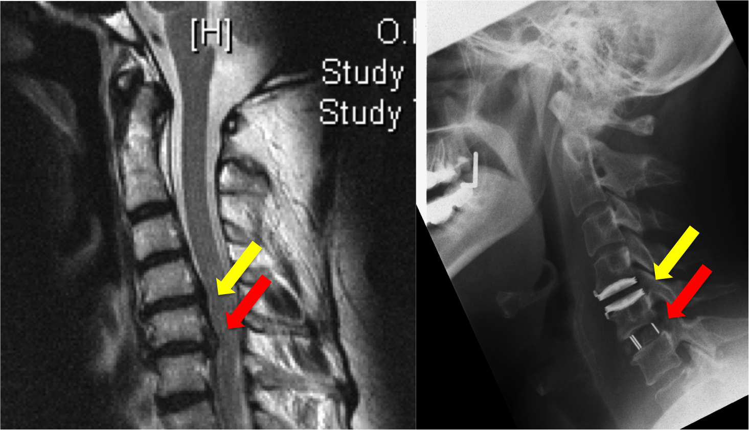 Links vor und rechts nach einer Fusion (Stabilisierungsoperation) und Implantation einer Bandscheibenprothese der Halswirbelsäule (HWS).