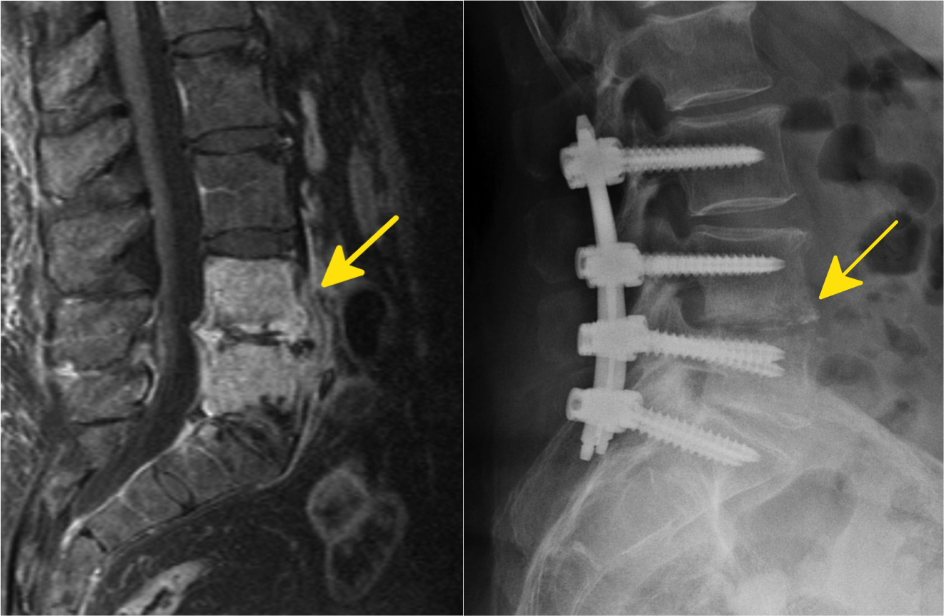 Links ein MRT mit einer schweren Entzündung der Wirbelkörper (Spondylitis) und der Bandscheibe (Spondylodiszitis). Rechts die Bilder nach der Stabilisierungsoperation des entzündeten Bereiches.