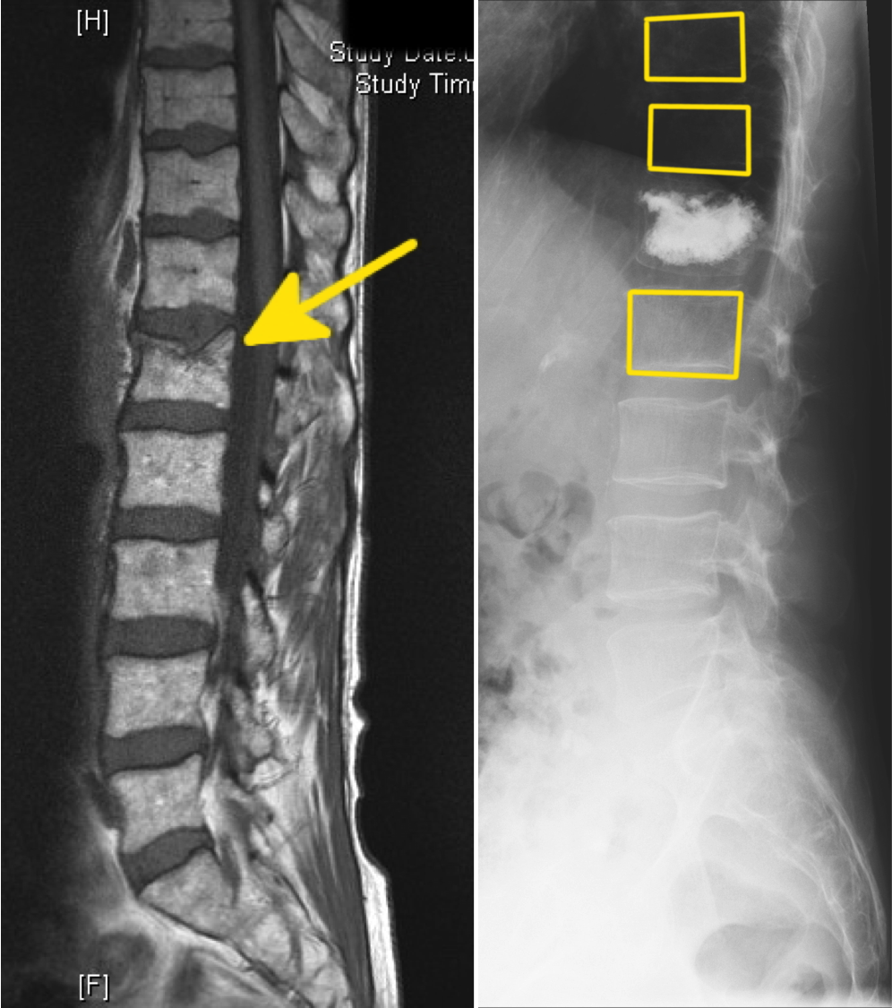 Auf der linken Seite der eingebrochene Wirbelkörper und die minimalinvasive Zementauffülung und Aufrichtung (=Kyphoplastie) auf der rechten Seite .