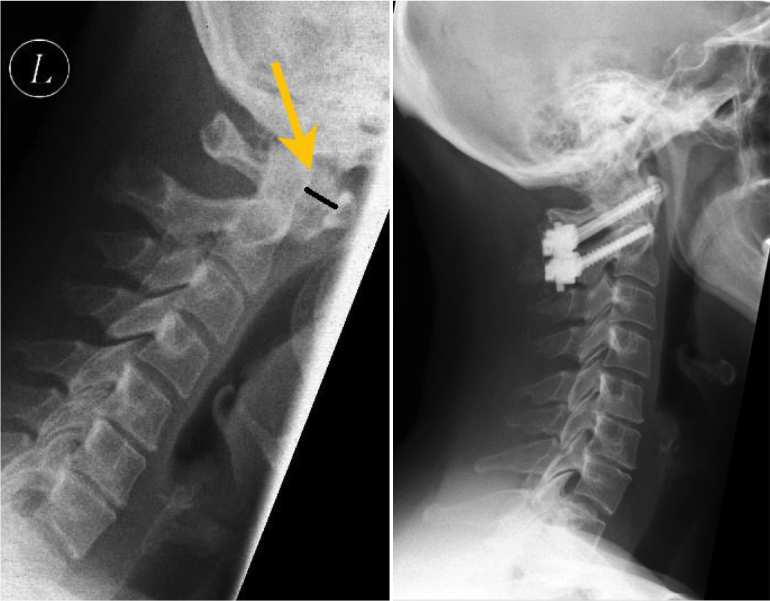 Auf dem linken Röntgenbild ist die Halswirbelsäule von der Seite abgebildet. Der schwarze Strich markiert den deutlich erweiterten Abstand des 1. Halswirbel (Atlas) zum 2. Halswirbel (Axis). Dieser Abstand dokumentiert die hochgradige Instabilität in diesem Bereich. Bei einer solchen Instabilität ist eine operative Stabilisierung notwendig. Das rechte Bild zeigt die operativ stabilisierte Halswirbelsäule - hier wurden der 1. Halswirbel (Atlas) mit dem 2. Halswirbel (Axis) von dorsal (hinten) verschraubt.